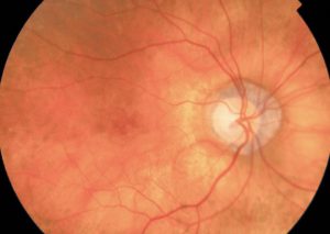 AGUJERO MACULAR