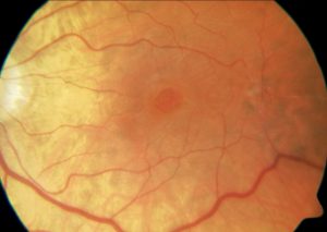 AGUJERO MACULAR