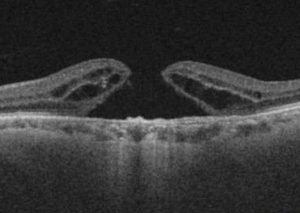 AGUJERO MACULAR OCT