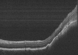 MELANOMA COROIDES