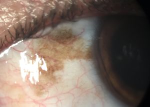 MELANOSIS CONJUNTIVAL