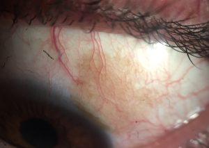 MELANOSIS CONJUNTIVAL_