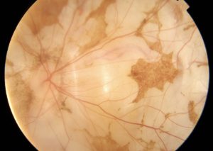 MIOPIA MAGNA ATROFIA MACULAR