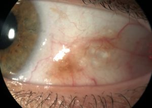NEVUS CONJUNTIVAL
