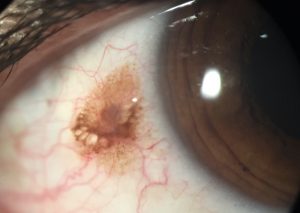 NEVUS CONJUNTIVAL