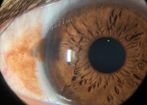 NEVUS CONJUNTIVAL