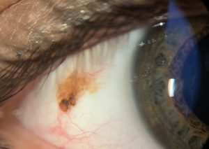 NEVUS CONJUNTIVAL