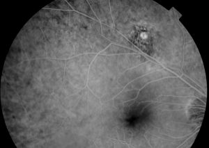 NEVUS COROIDEO