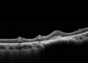 NEVUS COROIDEO