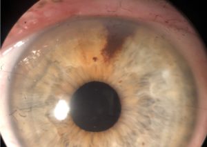 NEVUS IRIS