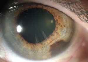 NEVUS IRIS