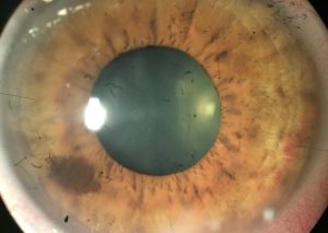 NEVUS IRIS