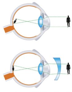 REFRACCION ASTIGMATISMO