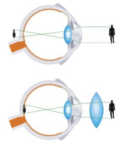 REFRACCION HIPERMETROPIA