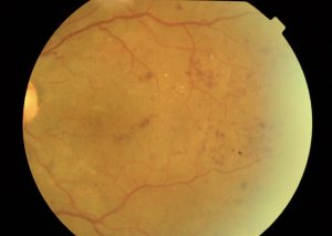 RETINOPATIA DIABETICA