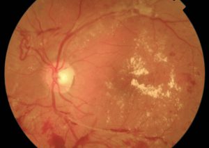 RETINOPATIA DIABETICA