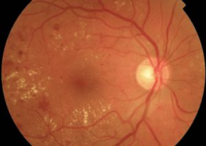 RETINOPATIA DIABETICA