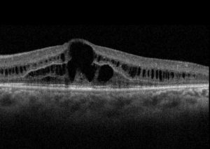 RETINOSQUISIS JUVENIL OCT