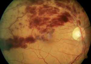 TROMBOSIS RETINA