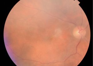 TRACCION VITREO MACULAR