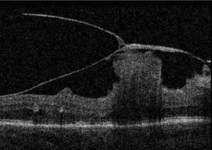 TRACCION VITREO MACULAR OCT