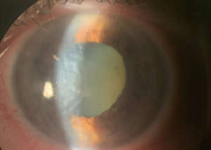 GLAUCOMA AGUGO