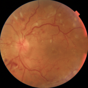 RETINOPATIA DIABETICA