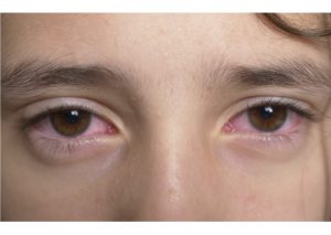 CONJUNTIVITIS 2
