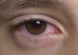 CONJUNTIVITIS VIRICA