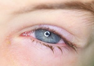 CONJUNTIVITIS BACTERIANA