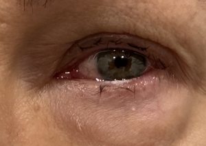 CONJUNTIVITIS VIRICA