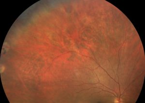 DESGARRO RETINA PERIFÉRICO
