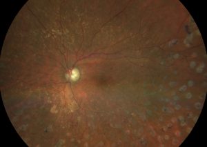 OCLUSION DE RAMA VENOSA RETINIANA