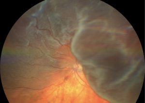 DESPRENDIMIENTO DE RETINA