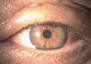 CONJUNTIVITIS ALÉRGICA