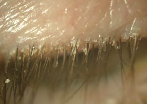 BLEFARITIS ANTERIOR