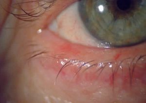 BLEFARITIS POSTERIOR
