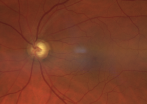 Glaucoma