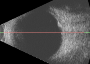 Nodulo focal escleral