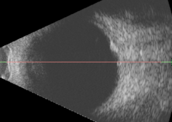 Nodulo focal escleral