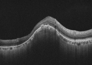 Nodulo focal escleral