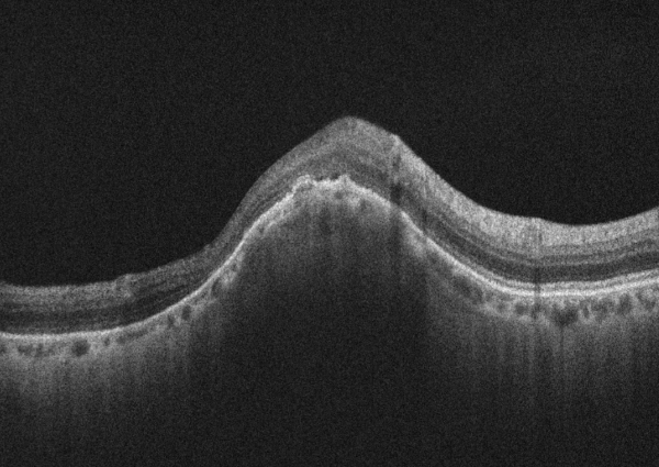 Nodulo focal escleral