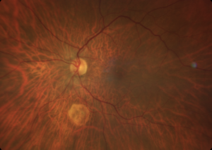 Nodulo focal escleral