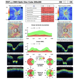 OCT glaucoma