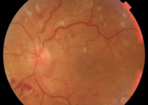 RETINOPATIA DIABETICA PROLIFERATIVA