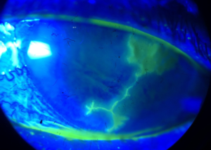 herpes ocular_dendrita corneal