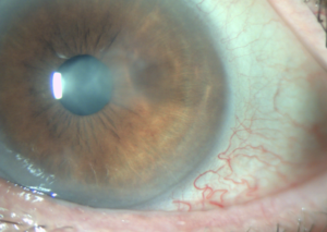 leucoma corneal herpetico