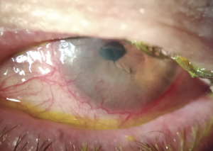 leucoma vascularizado corneal