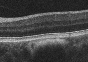 nevus coroideo
