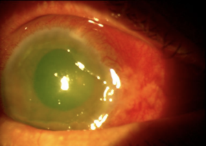 uveitis herpetica